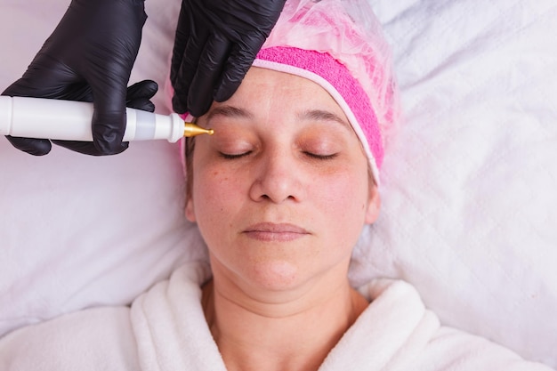 Co ile można robić dermapen, by uzyskać najlepsze efekty?