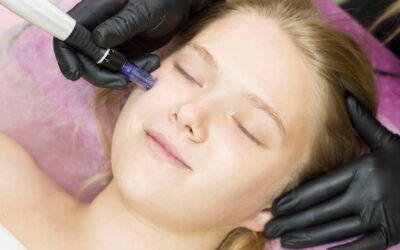 Dermapen jak używać w domowym zaciszu?