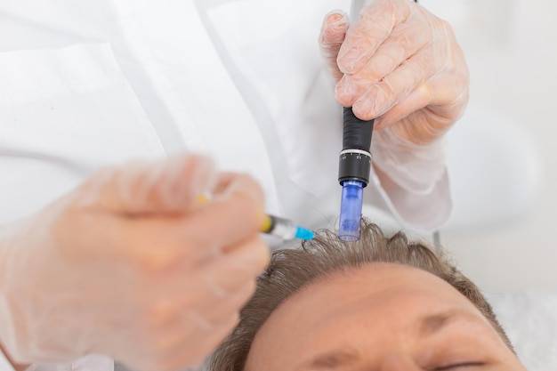 Jak często robić mezoterapię mikroigłową, żeby zauważyć efekty?