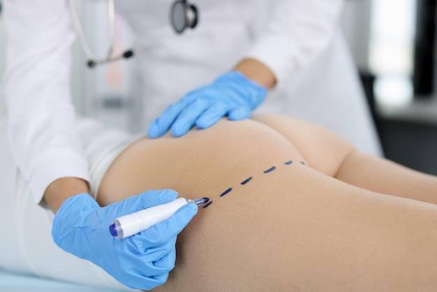 Mezoterapia igłowa na cellulit czy działa naprawdę?