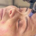 Dermapen jak działa i kiedy warto sięgnąć po ten zabieg?
