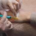 Osocze bogatopłytkowe co to jest i kiedy warto je stosować?
