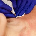 Ile goi się skóra po dermapenie i czego można się spodziewać?