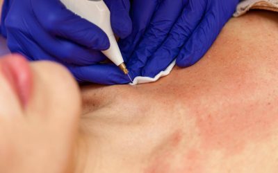 Ile goi się skóra po dermapenie i czego można się spodziewać?