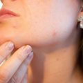 Jak dezynfekować derma roller w domowych warunkach?